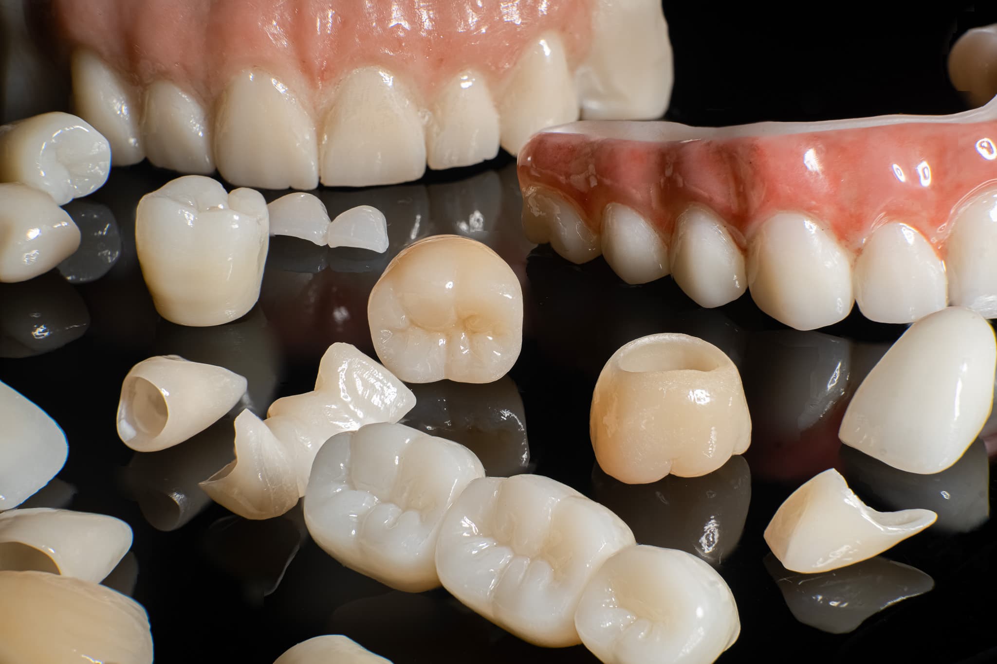 Implant Restorations